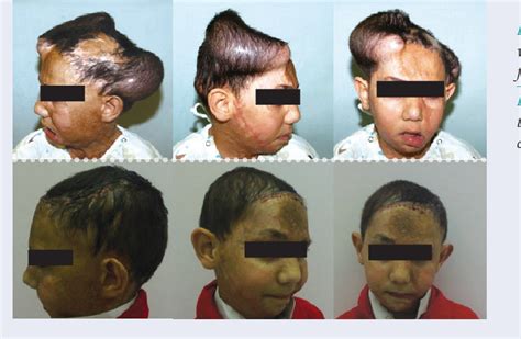 Figure 1 3 From The Use Of Tissue Expansion In Burn Deformity