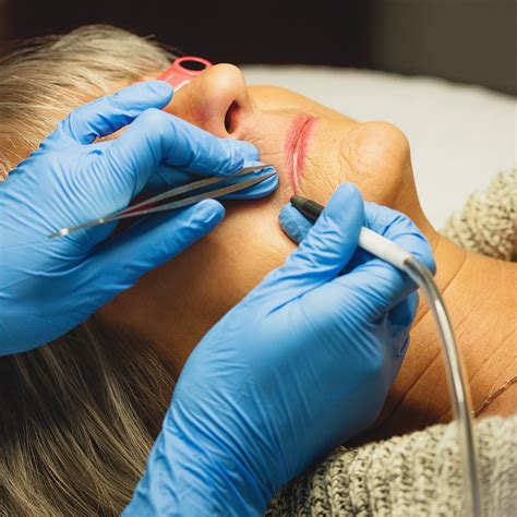 If you leave this on past the specific time, even by about ten seconds, it will start to sting. Facials, Chemical Peels for Acne Scar, Hyperpigmentation ...