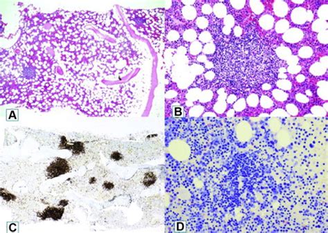 Cold Agglutinin Mediated Autoimmune Hemolytic Anemia