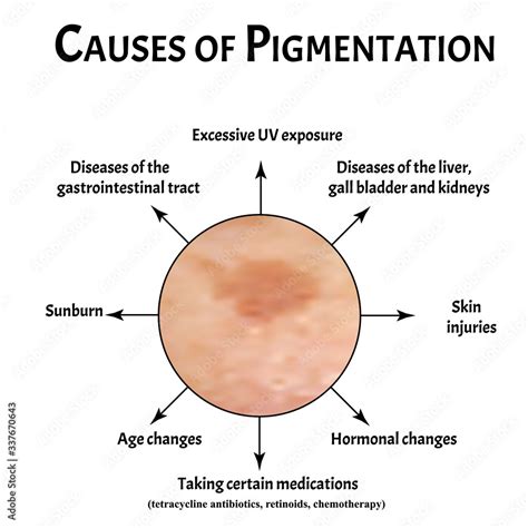 Pigmentation On The Skin Causes Brown Spots On The Skin Pigmentation