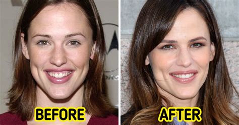 Celebrities Who Decided To Change Their Teeth And Started Shining