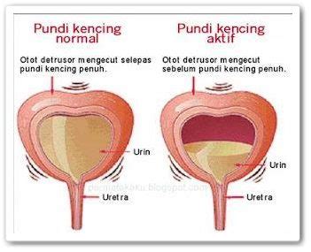 Kerosakan buah pinggang tahap akhir menyebabkan kegagalan menapis darah, membuang sisa toksik, sisa buangan dan air berlebihan daripada badan. Oh! Bisikan Angin: Post Tahan Kencing Punca Kerosakan Buah ...