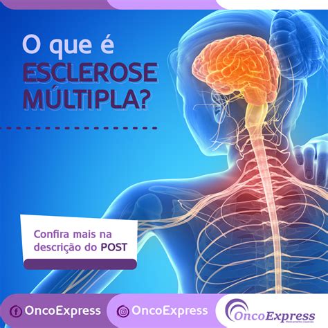 O Que é Esclerose MÚltipla Oncoexpress