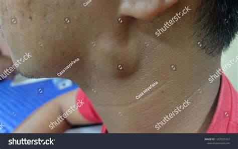 Preauricular Swelling Differential Diagnosis Parotid Swelling库存照片
