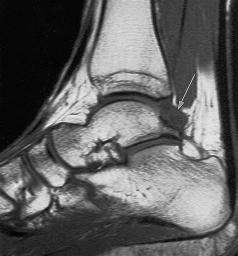 Anterior Ankle Impingement Syndrome Radiology Reference Article My XXX Hot Girl