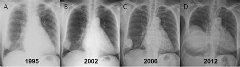 Serial Chest Radiographs From 1995 Through 2012 A The Download