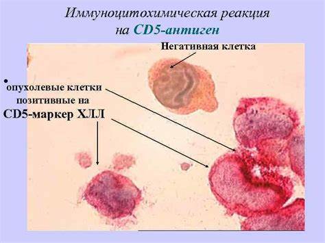 Хронический лимфолейкоз lympholeucosis chronica этиология патогенез Картинка - Хронический лимфолейкоз lympholeucosis chronica этиология патогенез