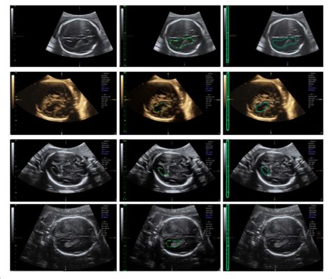 Ultrasound Fetal Brain Image From Left To Right The Columns Show The
