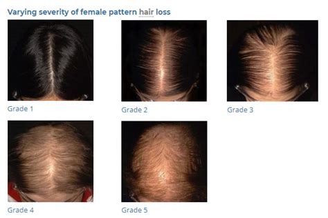 Patterned hair loss is the most common cause of hair loss seen in both the sexes after puberty. FEMALE PATTERN HAIR LOSS - MyNLrx
