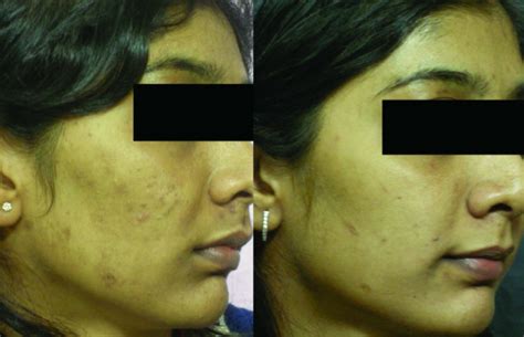 Glycolic Acid Peel Before And After