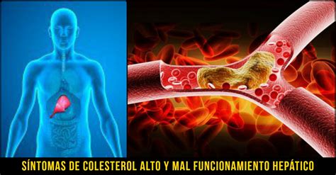 Síntomas De Colesterol Alto Y Mal Funcionamiento Hepático