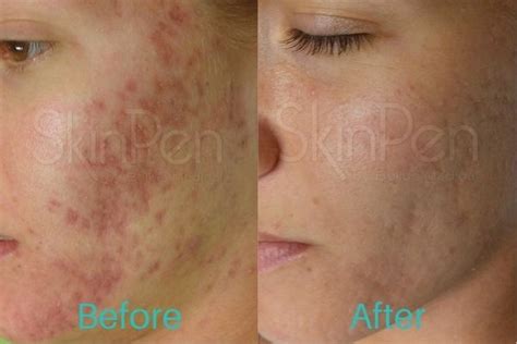 Microneedling Before And After Dermatology Center Of Atlanta
