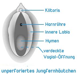 Sofern keiner der früheren ehegatten einen wohnsitz in deutschland hat und in deutschland auch keine neue ehe geschlossen werden soll, ist die. Jungfernhutchen Rekonstruktion Hymen