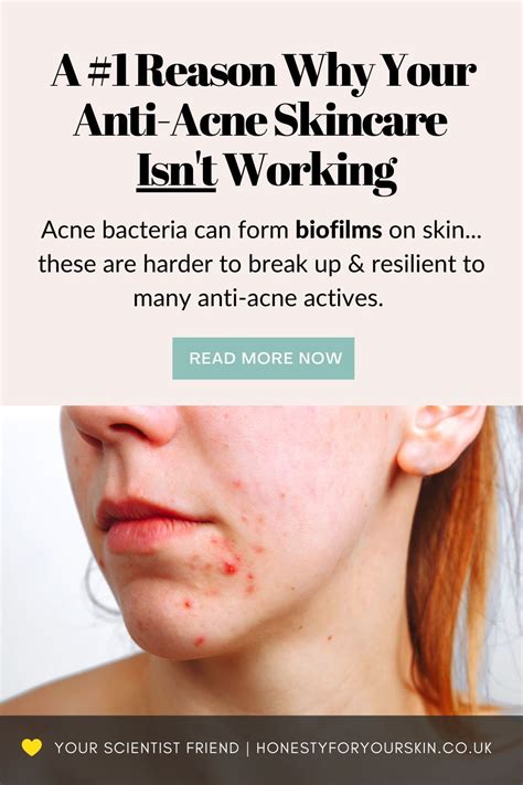 Acne Wont Go Away Help These Are The 5 Hidden Reasons Why Bad