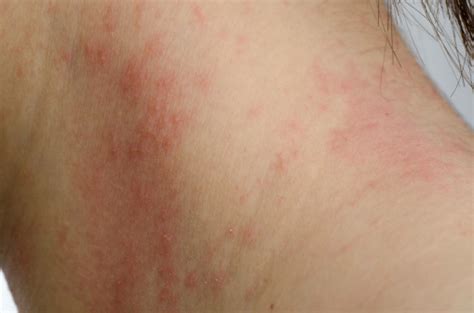 Photos Of Different Types Of Dermatitis Htq