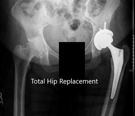Case Study Left Hip Total Replacement In 74 Year Old Male