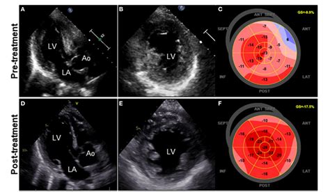 Figure 1 From The Diagnostic Challenge Of Eosinophilic Granulomatosis