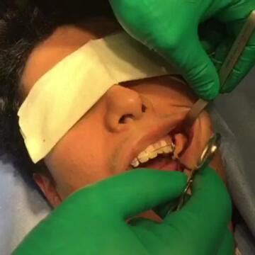 Buccal Fat Removal For Slimmer Cheeks Video RealSelf