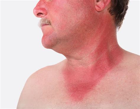 Sunburn Skin Disorder Britannica