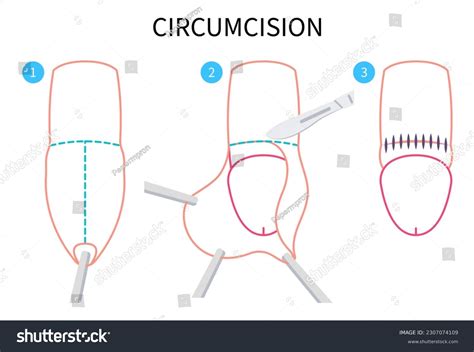 Circumcision Paraphimosis Phimosis Swelling Medical Anatomy Stock Vector Royalty Free