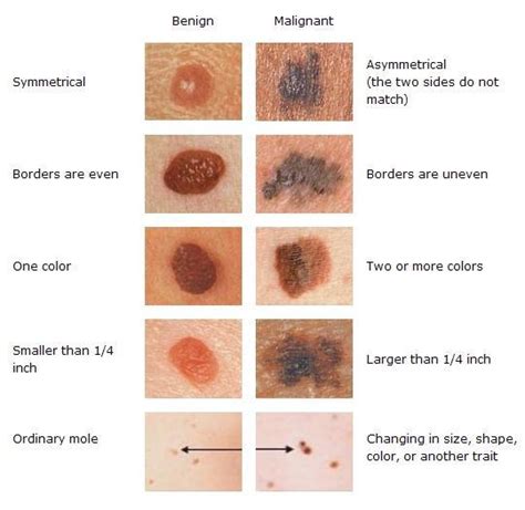 Skin Cancer Symptoms Of Skin Cancer Kimaja Farwani