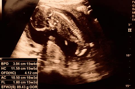 15 Weeks Pregnant Ultrasound Symptoms And Fetus
