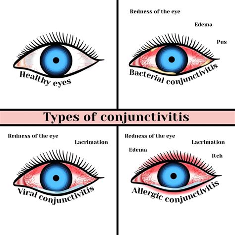 Virale konjunktivitis manifestiert sich als eine feine, diffuse pinkness der bindehaut, die für eine leicht verwechselt wird ciliare infektion der iris ( iritis ), aber bestätigende zeichen auf mikroskopie. 15 Pictures Of Conjunctivitis - Pain Relief Guidance