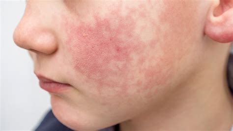Red Cheeks On Children Could Be A Sign Of A Virus