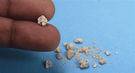 A Tcm Physician Reveals How Kidney Stones Can Be Treated With Tcm