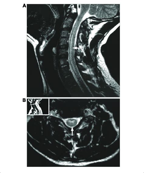 MRI Of A Poliovirus AFM Patient The MRI Presents A Sagittal A And