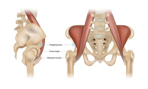 Persistent Groin Pain After Hip Replacement