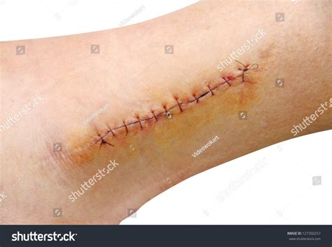 Stitches In The Leg Ankle Stock Photo 127350257 Shutterstock