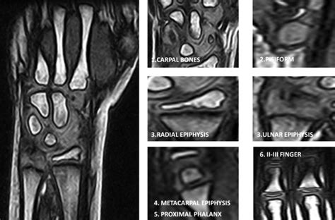It can be identified by the layer of basophilic hyaline cartilage. Male, 5 years old. The epiphyseal plate of the radius is wide open and... | Download Scientific ...