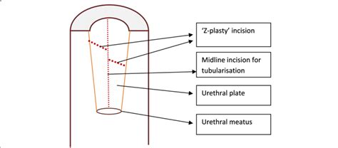 Schematic Representation Of The Z Plasty Incision Given Along With The