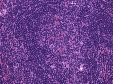 Mantle Cell Lymphoma