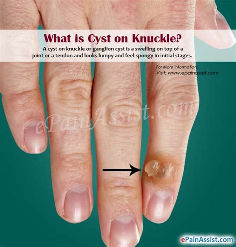 Cyst On Knucklecausessymptomshome Remedies