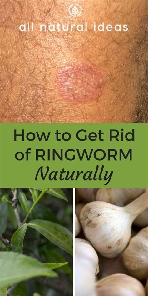 How To Get Rid Of Ringworm Fast With Natural Methods Get Rid Of