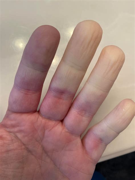 This Is What My Raynauds Looks Like Every Day In The Morning Its Normal I Get Busy And