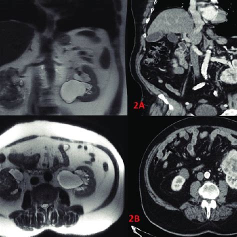 Renal Masses With Renal Sinus Invasion 1a Coronal T2 Weighted Mr