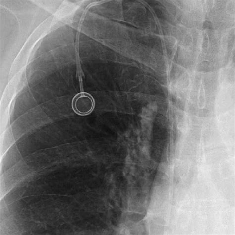 Chest Pa Shows Placement Of An Implantable Venous Access Port Ivap