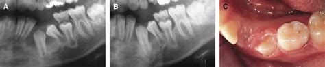 Spontaneous Eruption Of A Canine After Marsupialization Of An Infected