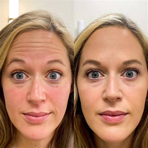Everything You Need To Know About Botox Before And After Botox Photos