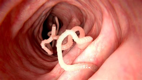 Welche anti parasitenkuren sind für den menschen geeignet? Parasiten im Darm - verstehen, erkennen, loswerden