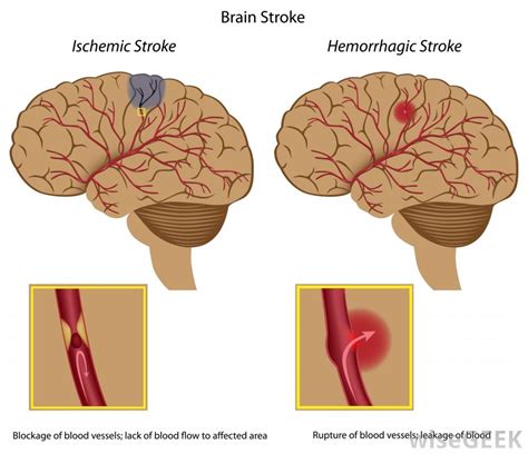 Learn about the different types of stroke (ischemic stroke, hemorrhagic stroke), warning signs, symptoms, causes, treatment and prevention of each, including four fast signs and symptoms. Stroke - ischaemic. Causes, symptoms, treatment Stroke ...