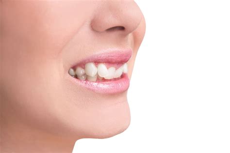 Jutted Tooth Treatment Options Warsaw In Cosmetic Dentistry