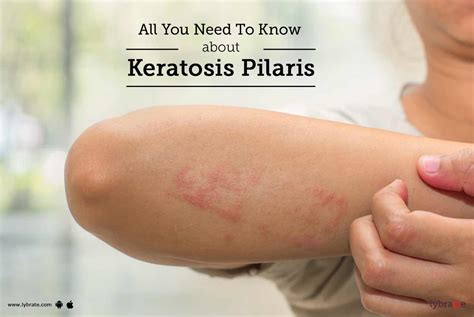 Keratosis Pilaris Signs Causes Treatment And Prevention By Dr