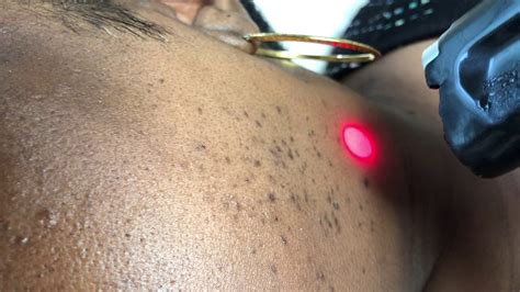 Do you want to remove hair with ease, with no razor burn and no ingrown hairs? Facial laser hair removal on black female face, jaw line ...