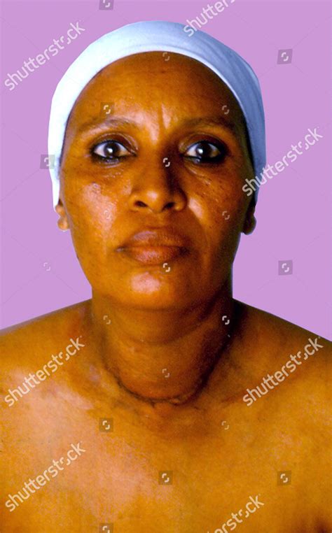 Patient Recovering Thyroidectomy Surgical Removal All Editorial Stock