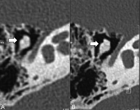 Temporal Bone Ct Improved Image Quality And Potential For Decreased