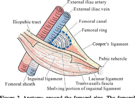 Figure 2 From Femoral Hernia A Review Of The Clinical Anatomy And Surgical Treatment